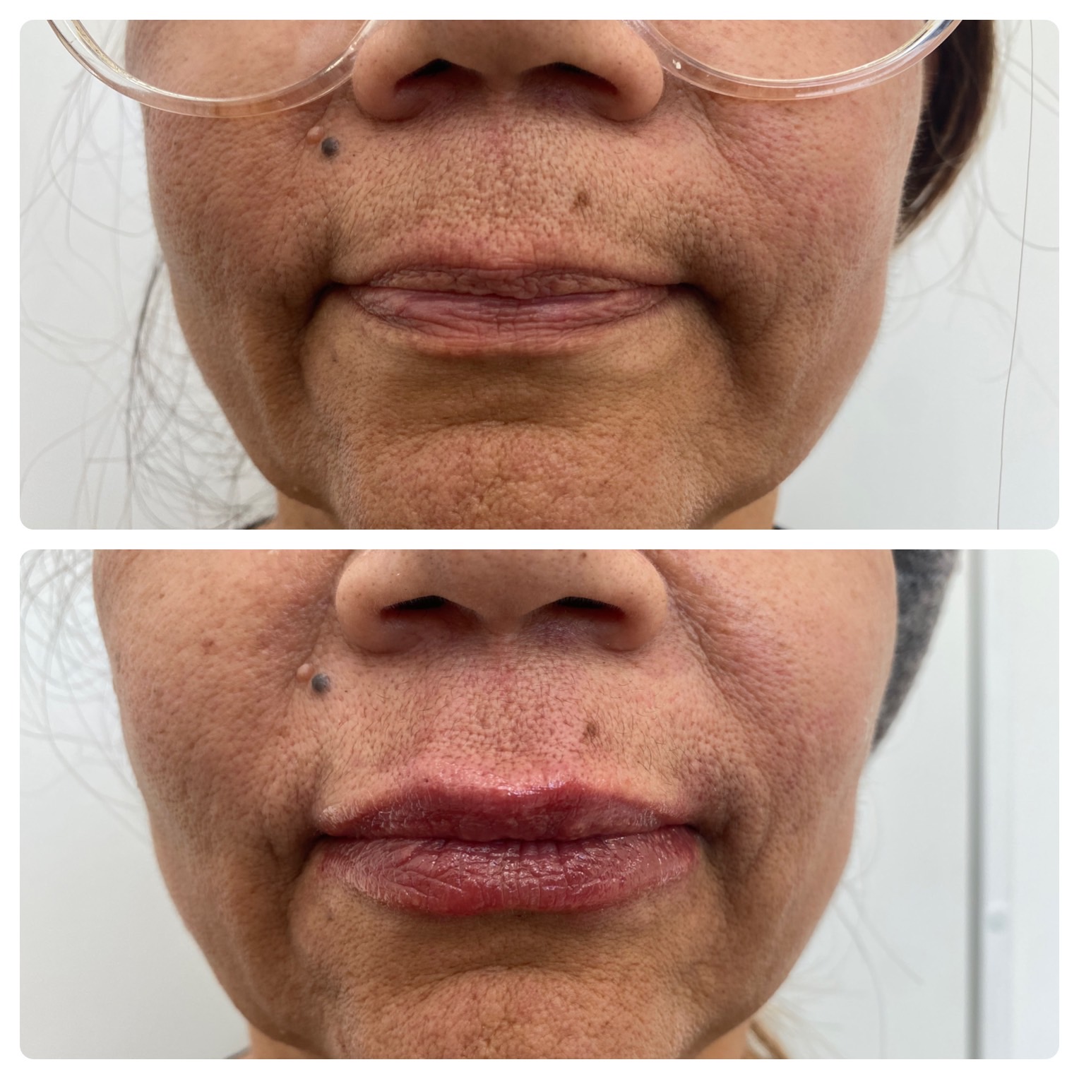 Preenchimento Labial